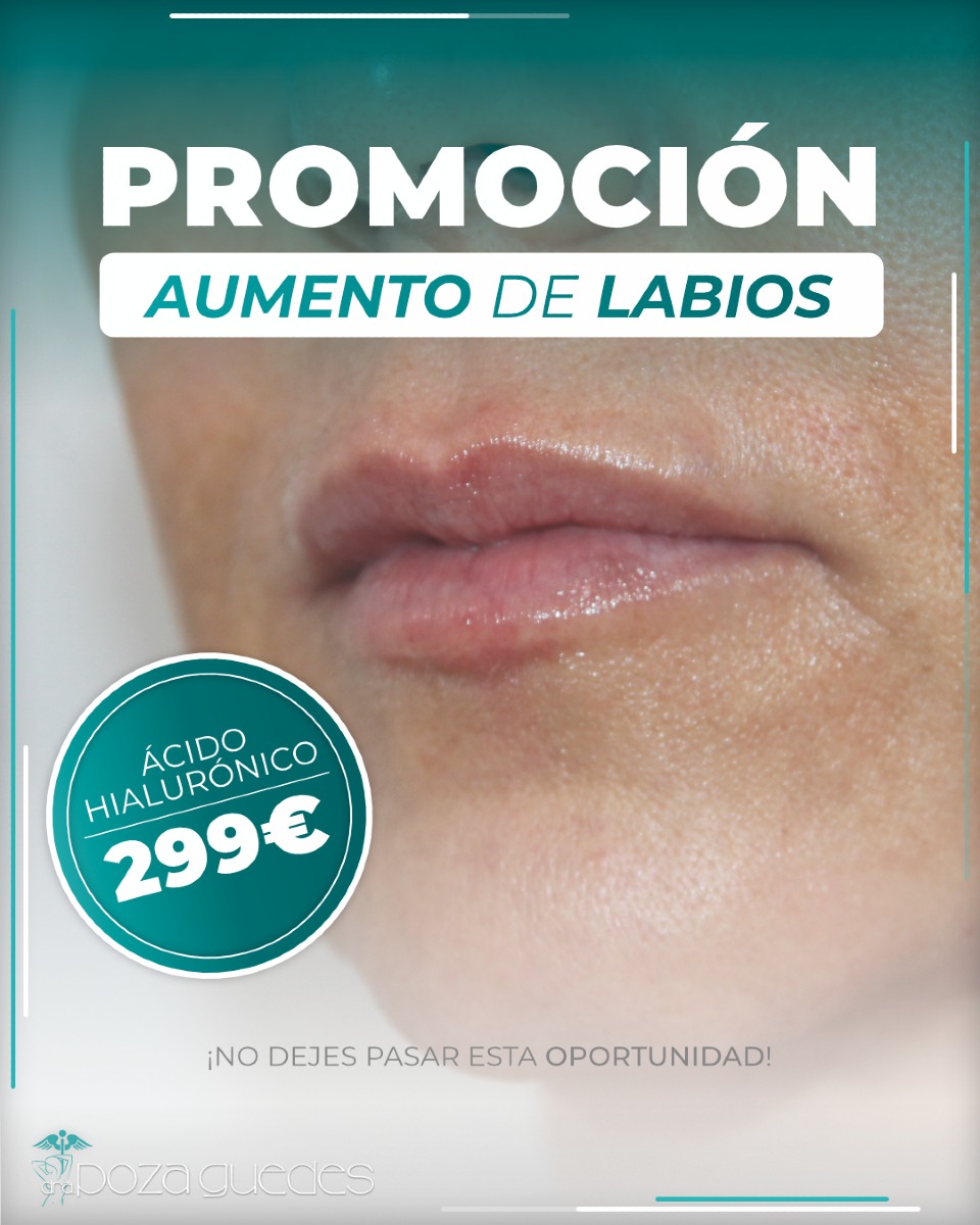 Aumento de labios con ácido hialurónico en Las Palmas por solo 299€ durante Marzo de 2025
